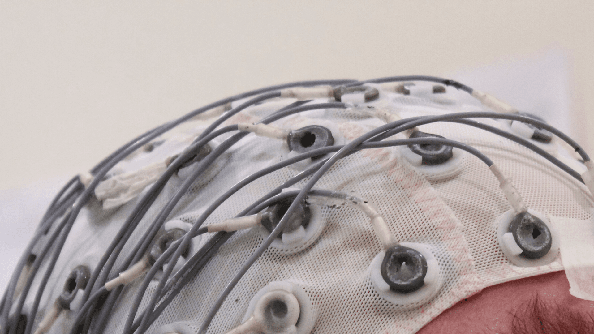 Epilepsy and IQ: How Seizures, Their Causes and Their Treatment Relate to Intelligence