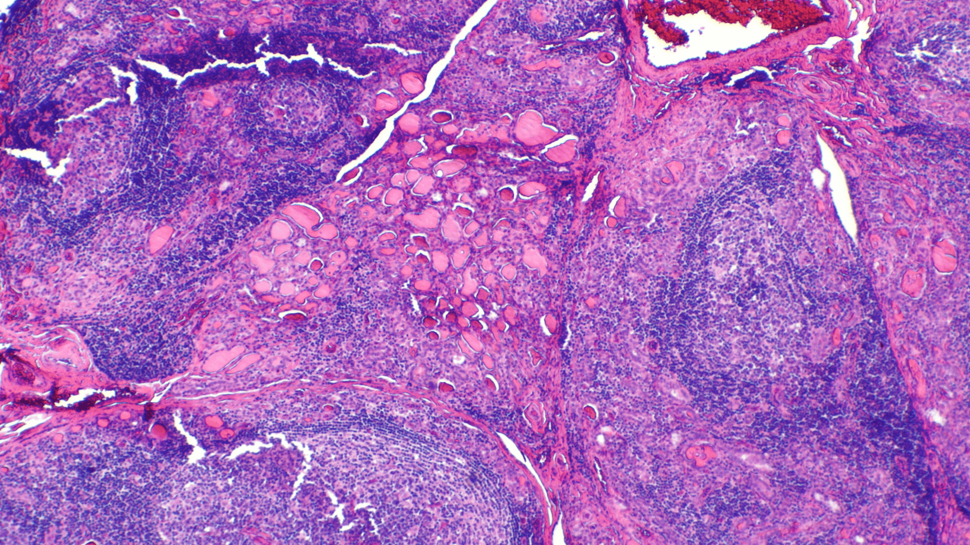 Hypothyroidism and IQ: Can an Underactive Thyroid Affect Intelligence?