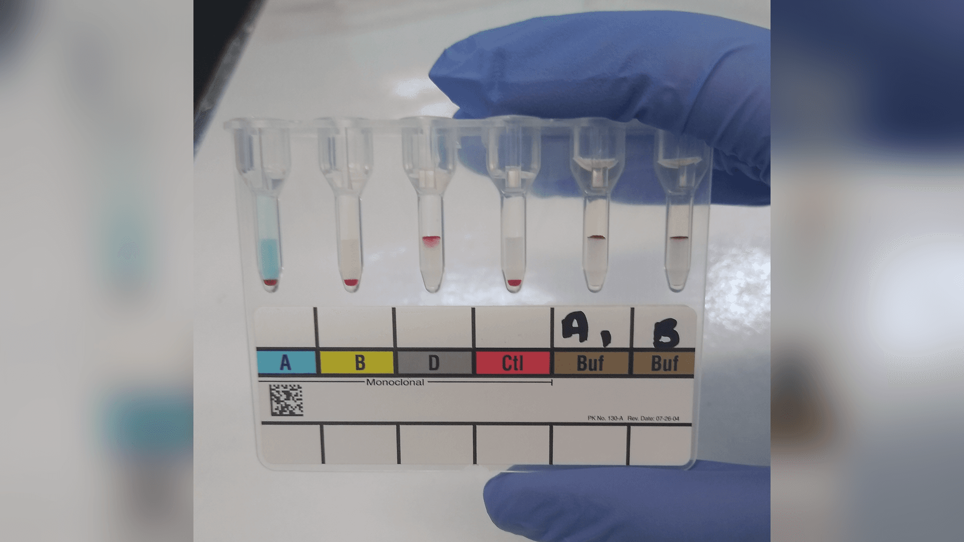 Blood Type and IQ: Is Your Blood Group Linked to Intelligence?