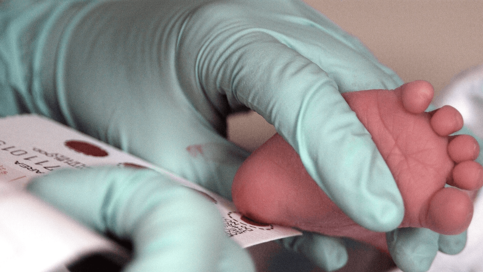 Congenital Hypothyroidism and IQ: How Newborn Screening Changed the Outcome