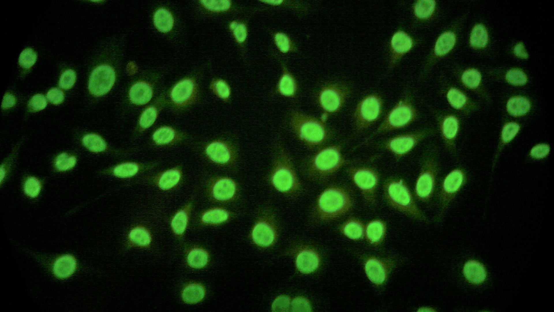 Lupus and IQ: Does Lupus Affect Intelligence and Thinking Skills?