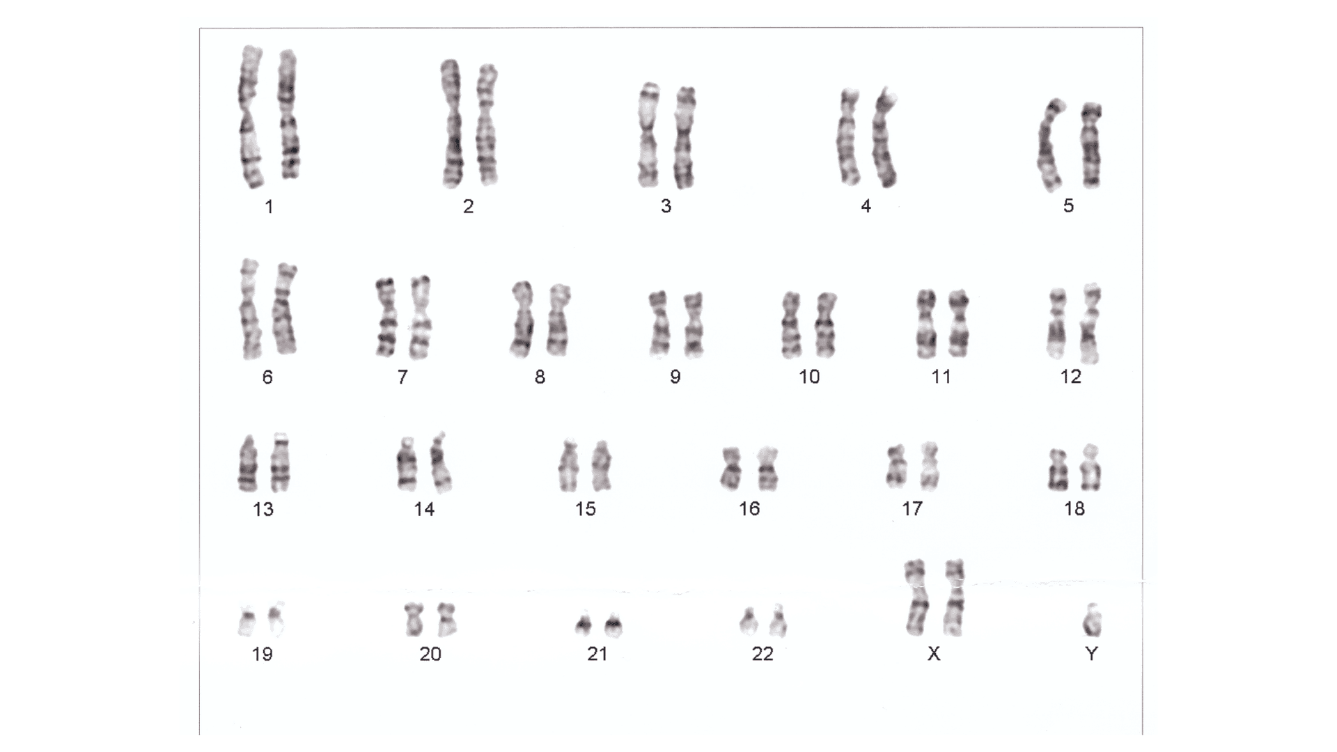 Klinefelter Syndrome and IQ: Mostly Average Scores With a Language Weakness