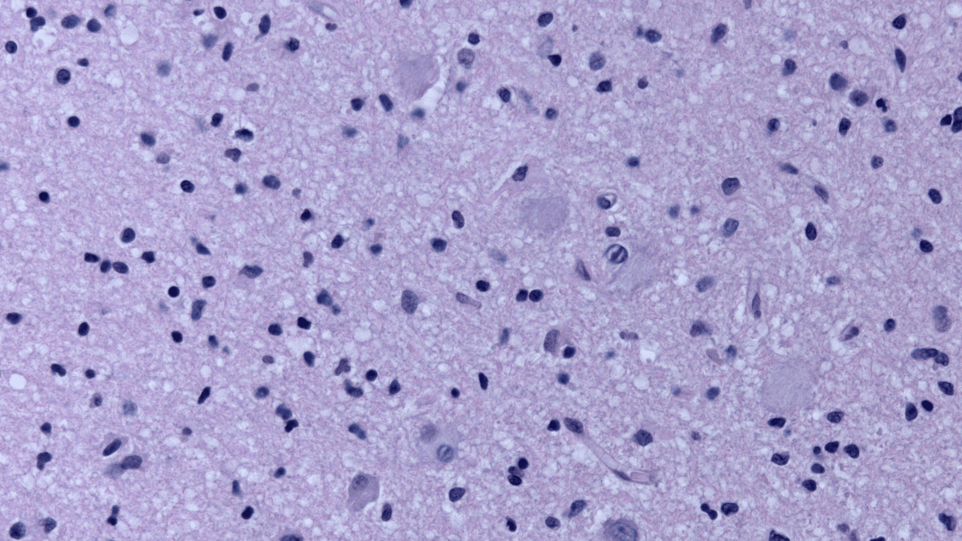 Tuberous Sclerosis and IQ: The Two-Peaked Distribution and Why Early Seizures Matter